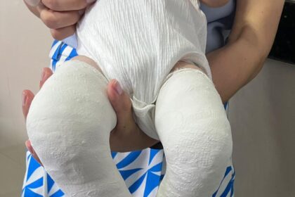 Cirurgias para tratar pé torto melhoram a vida de crianças em Aparecida de Goiânia