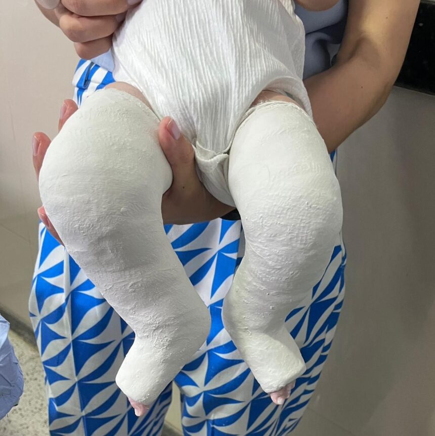 Cirurgias para tratar pé torto melhoram a vida de crianças em Aparecida de Goiânia